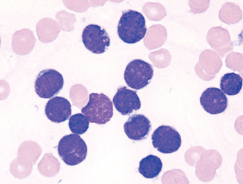 Image: Blood smear of precursor B-cell acute lymphoblastic leukemia (Photo courtesy of Peter Maslak).